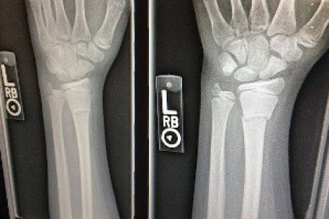 Zwei Röntgenbilder einer gebrochenen Hand